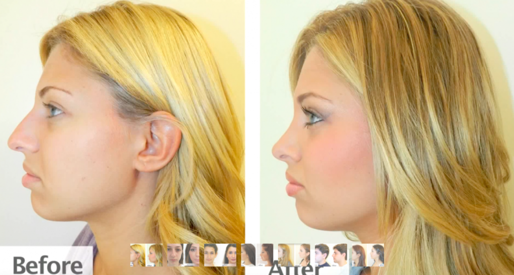 Best Rhinoplasty Surgery Famous Top Surgeon In Beverly Hills Ca 